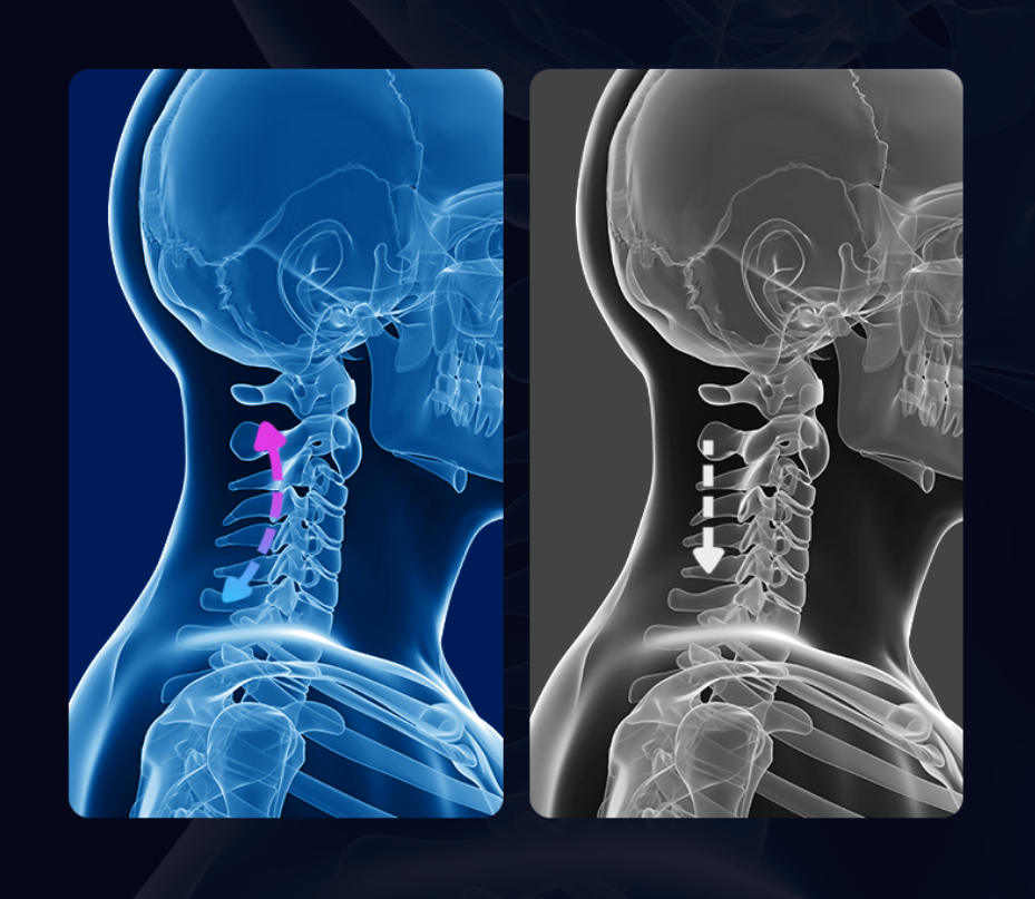 Cervical Neck Traction